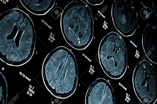 Mri brain anatomy neoplasticism stockphoto - neoplasticism free wallpaper